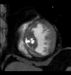 Prior Myocardial Infarction - CTisus CT Scan