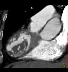 Prior Myocardial Infarction - CTisus CT Scan
