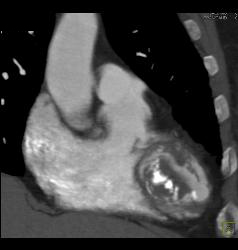 Prior Myocardial Infarction - CTisus CT Scan