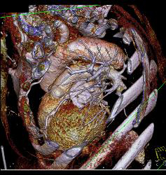 Supravalvular Stenosis and Prior Myocardial Infarction - CTisus CT Scan