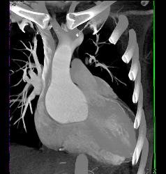 Dilated Root in Marfan Syndrome - CTisus CT Scan