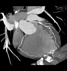 Coronary Artery Disease With Plaque - CTisus CT Scan