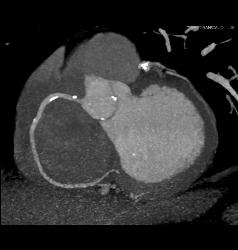 Plaque in Left Anterior Descending Coronary Artery (LAD) and Right Coronary Artery (RCA) - CTisus CT Scan