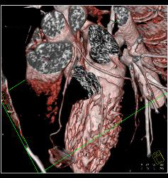 Normal Left Anterior Descending Coronary Artery (LAD) and Circumflex Artery (CX) - CTisus CT Scan