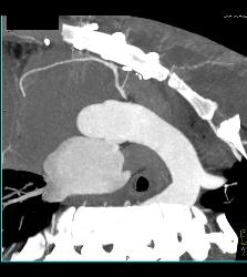 S/p Left Internal Mammary Artery (LIMA) and Venous Coronary Artery Bypass Graft (CABG) - CTisus CT Scan