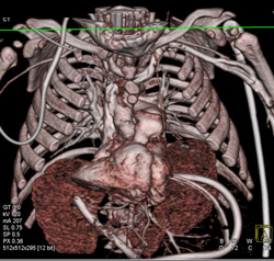 Pentalogy of Cantrell. Note Abdominal Wall Defect and Heart Extending Through Defect and Pulmonary Artery Stenosis - CTisus CT Scan
