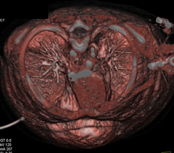 Pentalogy of Cantrell. Note Abdominal Wall Defect and Heart Extending Through Defect and Pulmonary Artery Stenosis - CTisus CT Scan