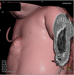 Pentalogy of Cantrell. Note Abdominal Wall Defect and Heart Extending Through Defect and Pulmonary Artery Stenosis - CTisus CT Scan