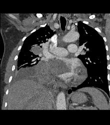 Lung Cancer Invades the Left Atrium - CTisus CT Scan