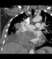 Lung Cancer Invades the Left Atrium - CTisus CT Scan