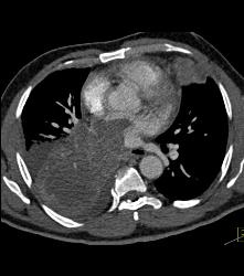 Lung Cancer Invades the Left Atrium - CTisus CT Scan