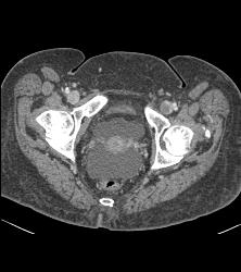 Incidental Pulmonary Embolism (PE) and Left Deep Vein Thrombosis (DVT) - CTisus CT Scan