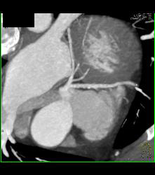 Left Anterior Descending Coronary Artery (LAD) Plaque - CTisus CT Scan