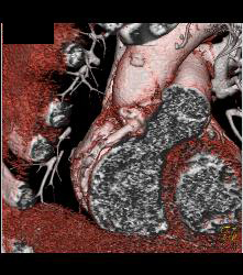 Dilated RCA At Reimplantation Site - CTisus CT Scan