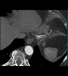 RCA Disease With Dilated RCA - CTisus CT Scan
