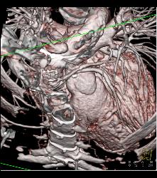 Multiple Bypass Grafts - CTisus CT Scan