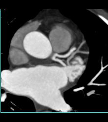 Left Anterior Descending Coronary Artery (LAD) and Circumflex Arise Directly Off the Left Cusp - CTisus CT Scan