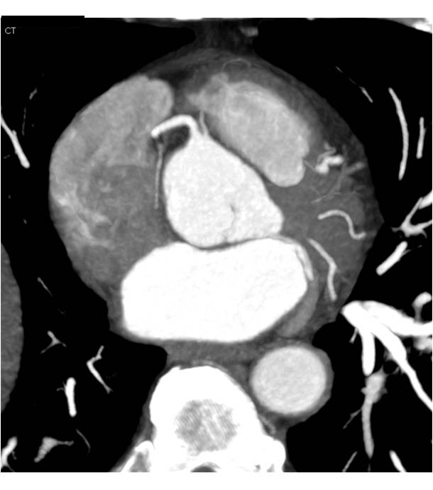 CCTA with Normal Coronary Arteries with SA Nodal Branch off Right Coronary Artery (RCA) and Conus Branch off Right Cusp - CTisus CT Scan