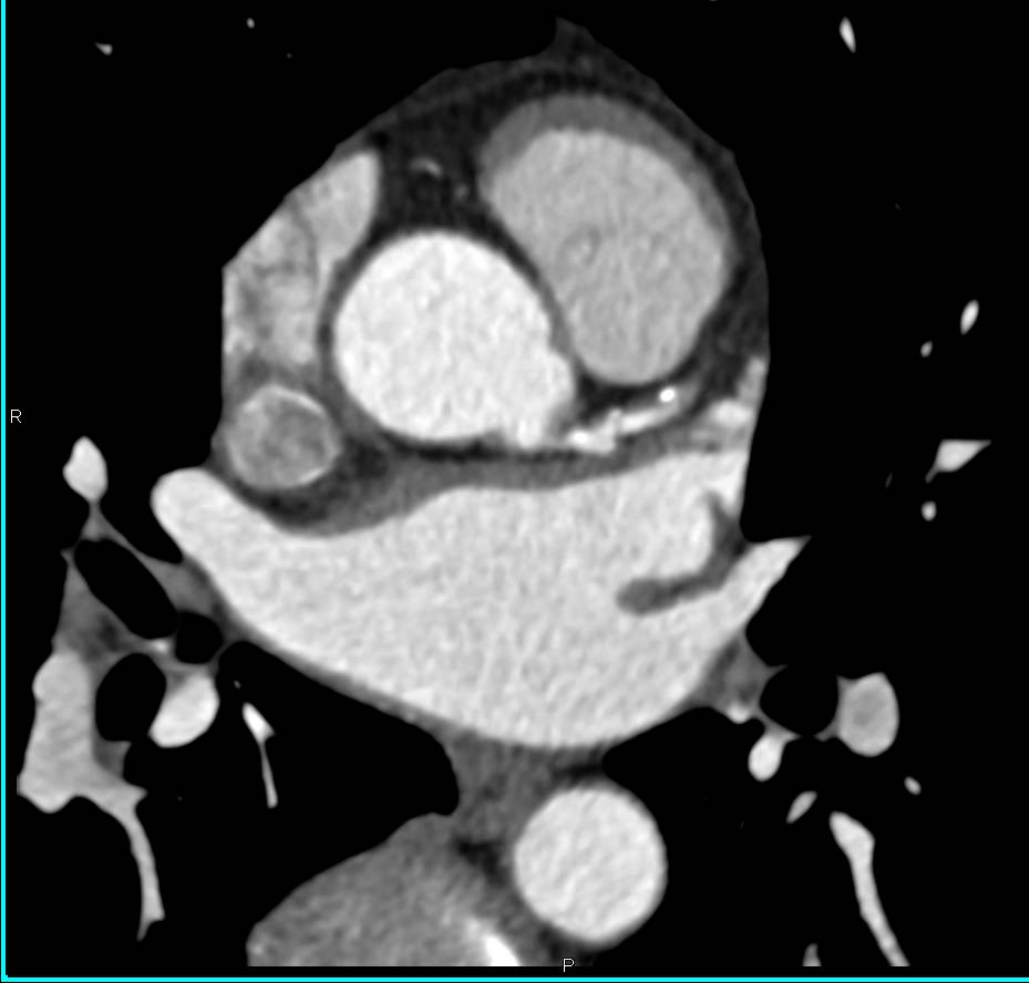 CCTA: Left Anterior Descending Artery (LAD) Plaque with a 50% Stenosis - CTisus CT Scan