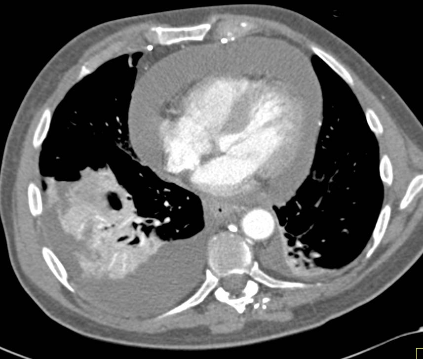 Pericardial Effusion - CTisus CT Scan
