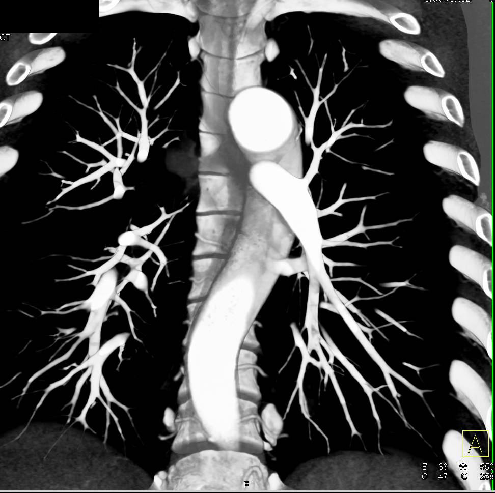 CCTA: Anomalous Right Coronary Artery Arising off the Left Cusp with Numerous 3D Views - CTisus CT Scan