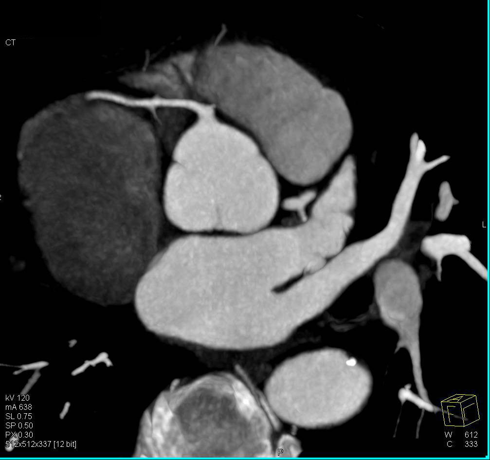 CCTA: Normal Coronary Artery Anatomy in 3D - CTisus CT Scan