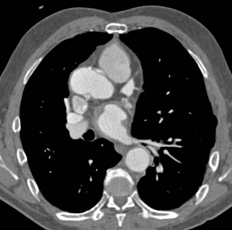 Left Main Coronary Artery Aneurysm at Bifurcation in a Patient with Aortic Dissection and Repair - CTisus CT Scan