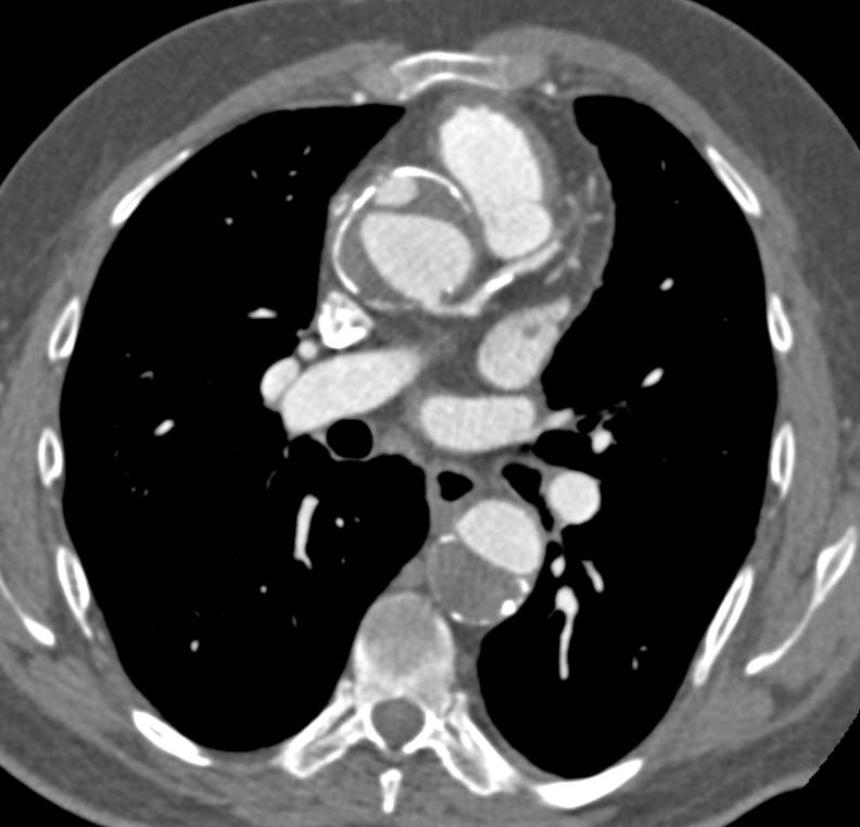 Type A Aortic Dissection - CTisus CT Scan