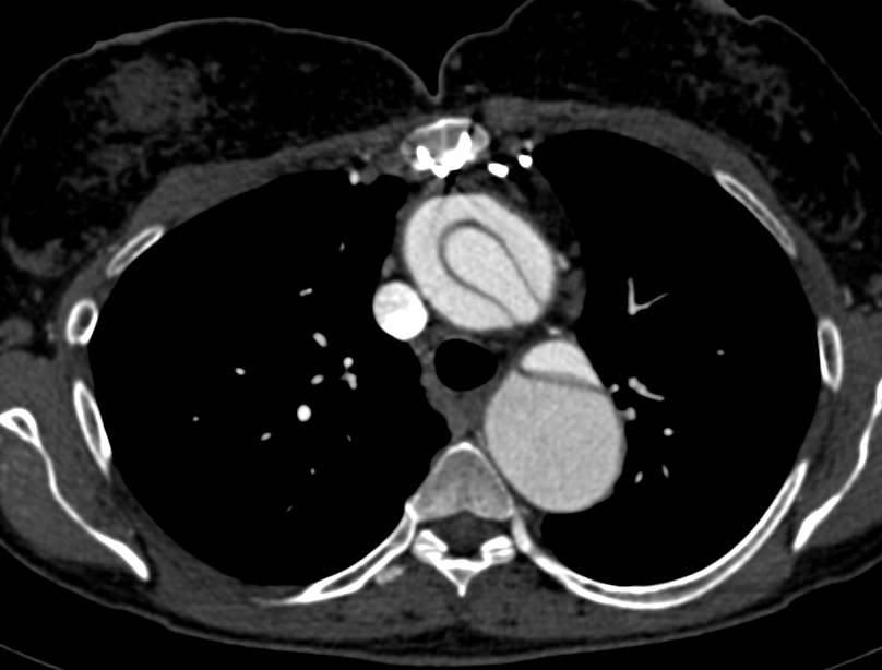 Type A Aortic Dissection with Repair and now Dissection extends down Thoracic Aorta and into Left Carotid Artery - CTisus CT Scan