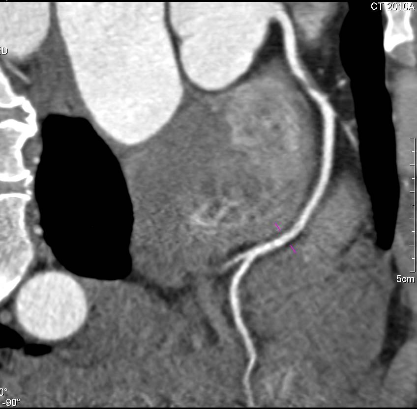 CCTA: Critical Stenosis Left Anterior Descending Coronary Artery (LAD) with Multiple MIP Views to Show Impact of Slab Thickness - CTisus CT Scan