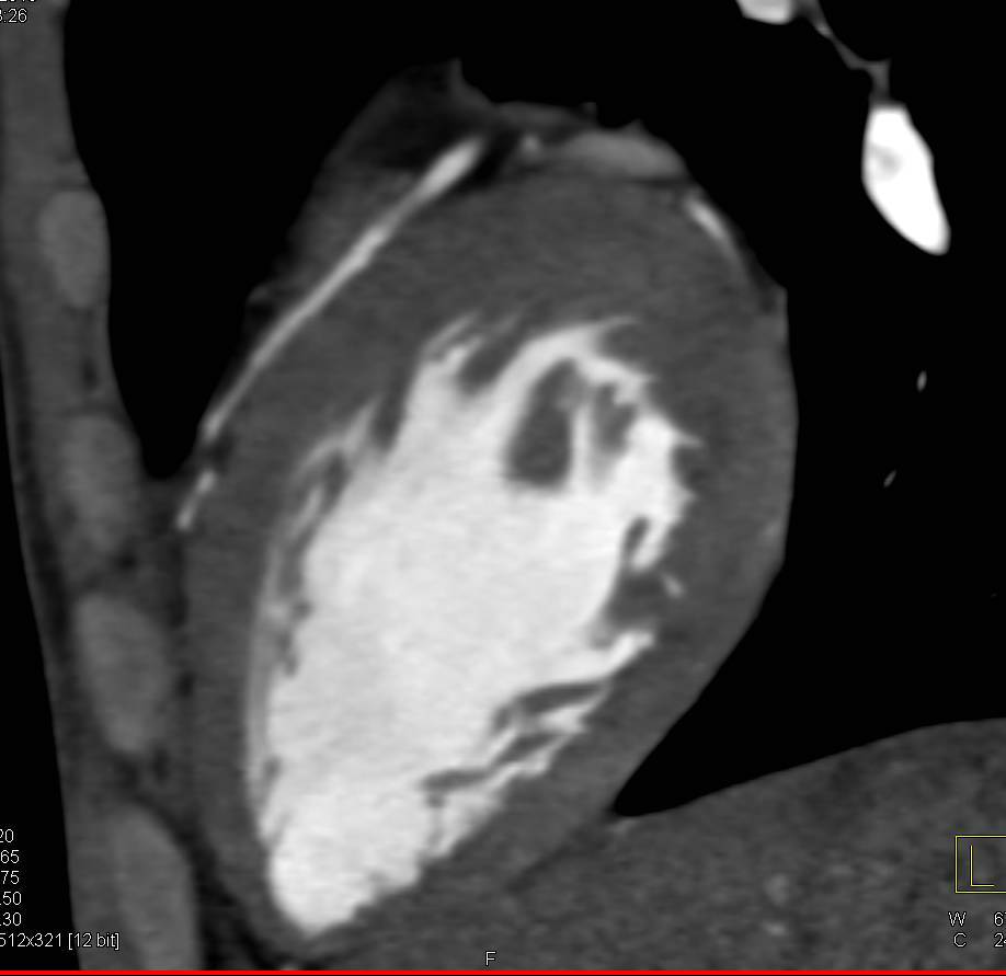 Normal Left Ventricle - CTisus CT Scan