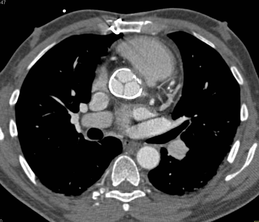 Calcification of the Ascending Aorta without Dissection - CTisus CT Scan