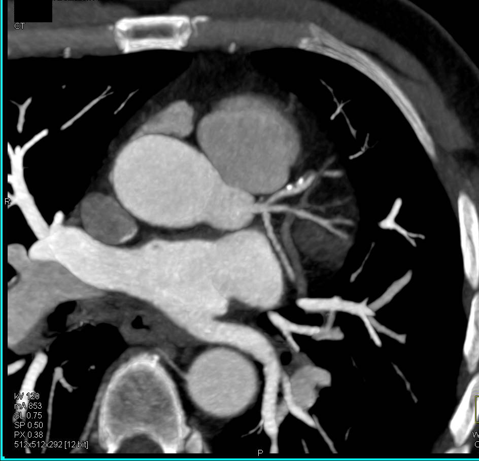 CCTA: Coronary Artery Disease with Mixed Plaque in Left Anterior Descending Coronary Artery (LAD) and Under 50% Stenosis - CTisus CT Scan