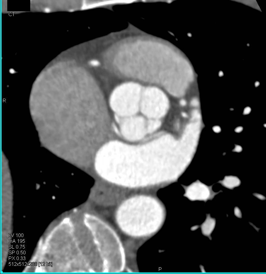 Anomalous Coronary Artery Anatomy with the Circumflex Arising off the Right Cusp in a Non-Malignant Configuration - CTisus CT Scan
