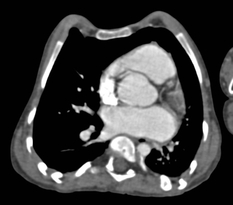 Marfan's Syndrome with a Dilated Sinus of Valsalva - CTisus CT Scan