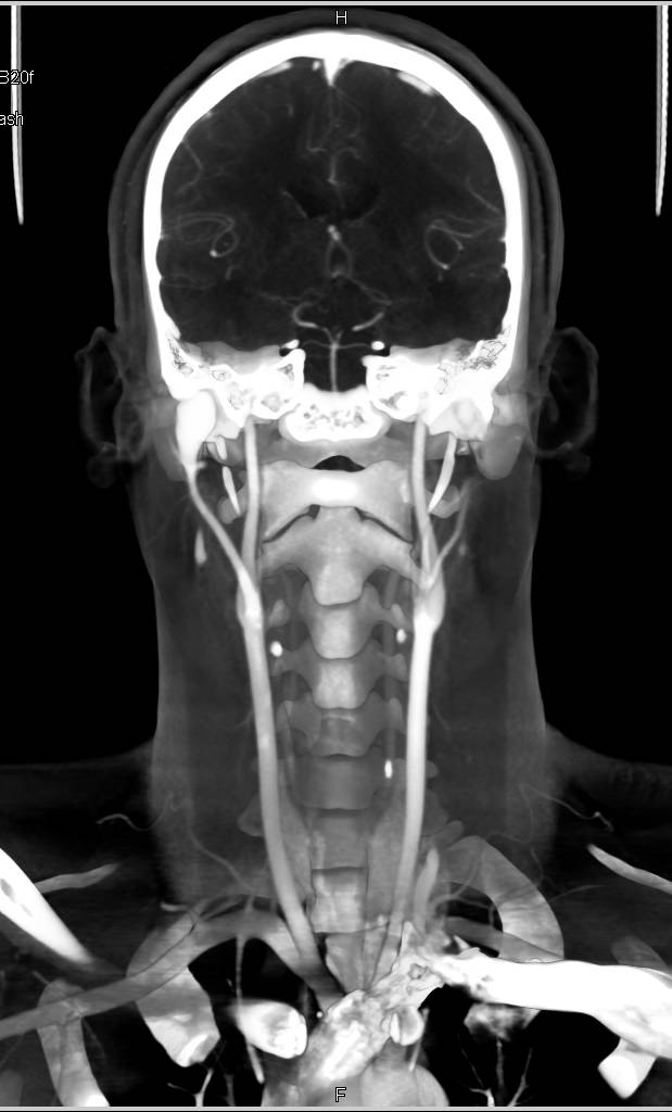 CTA of Aortic Valve Replacement (AVR) Repair and Normal Carotids with a Single Flash Acquisition - CTisus CT Scan