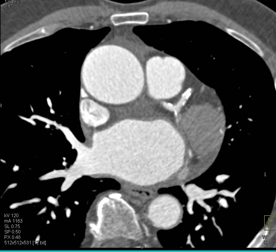 Dilated Ascending Aorta with Coronary Artery Disease - CTisus CT Scan