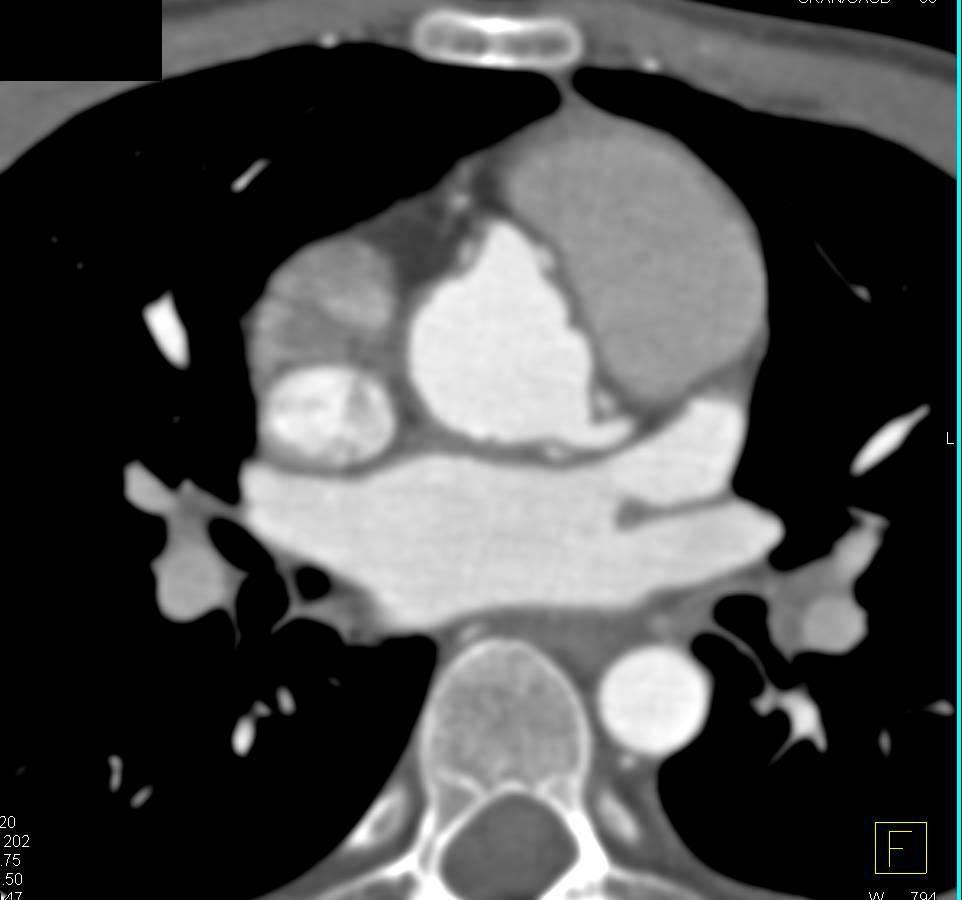 Aortic Root Repair with Reimplantation of the Coronary Arteries and Dilated Right Coronary Artery - CTisus CT Scan