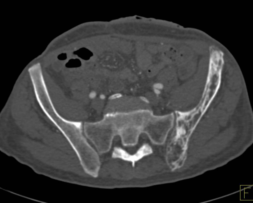 Paget's Disease as an Incidental Discovery in a Patient with SOB and Chest Pain - CTisus CT Scan