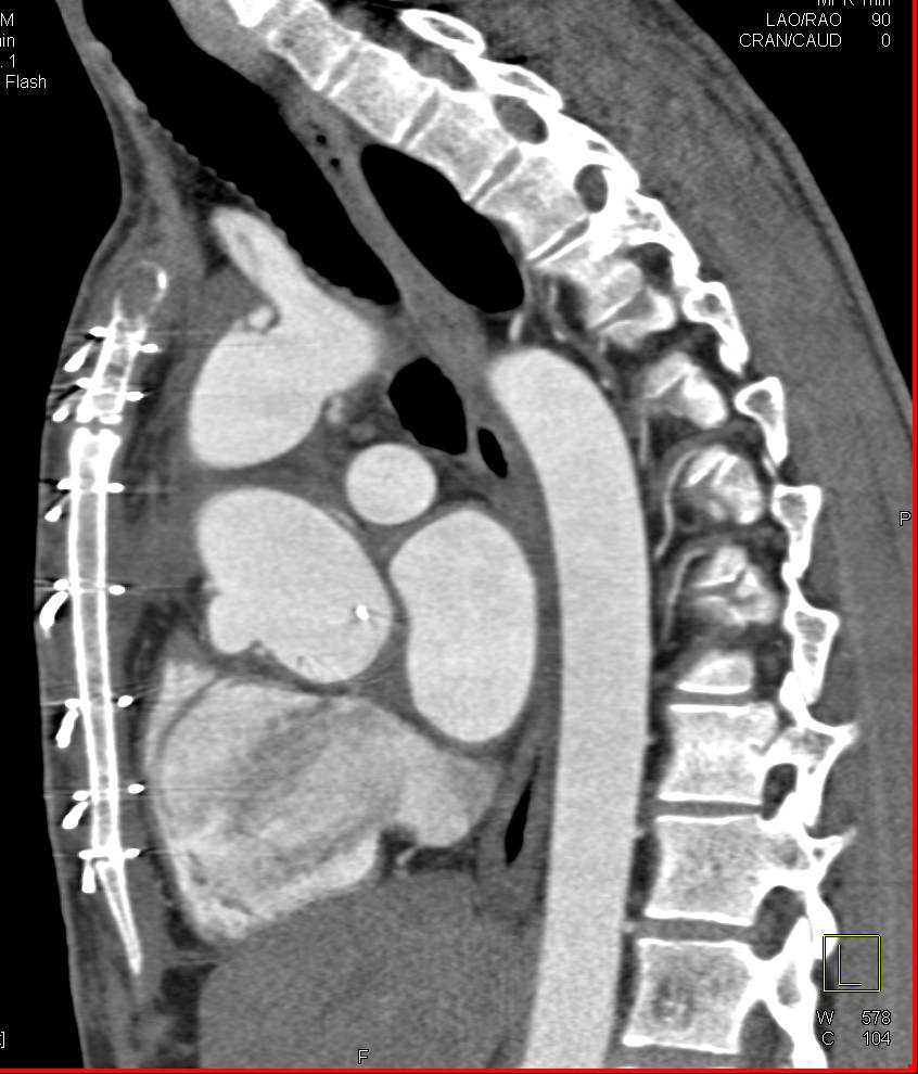 Marfan Syndrome with Composite Graft and Reimplanted Coronary Arteries. Right Coronary Artery (RCA) Dilated at the Anastomosis - CTisus CT Scan