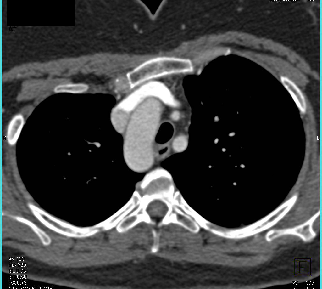 Double Aortic Arch with Mirror Branching - CTisus CT Scan
