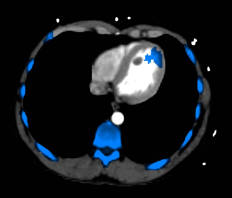 Automated Bone Removal Program Picks Up Infarct (old) in Left Ventricle - CTisus CT Scan