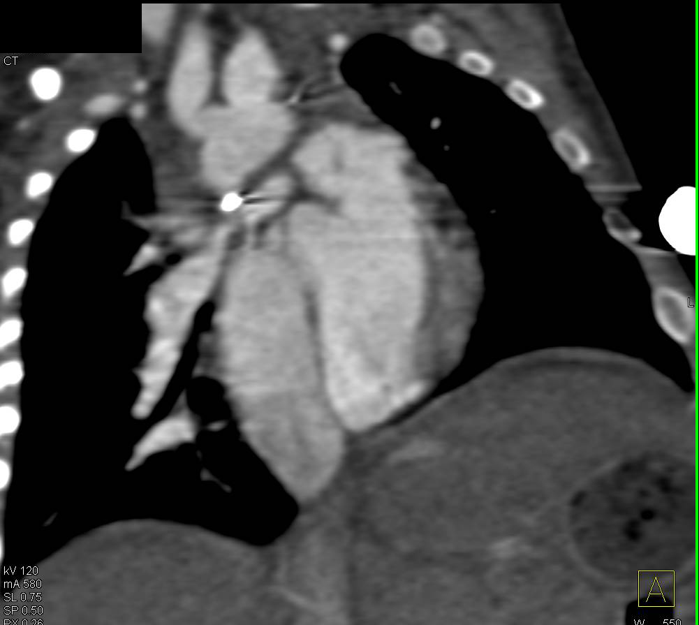 Pulmonary Artery Banding in a Tetralogy of Fallot (TOF) Patient - CTisus CT Scan