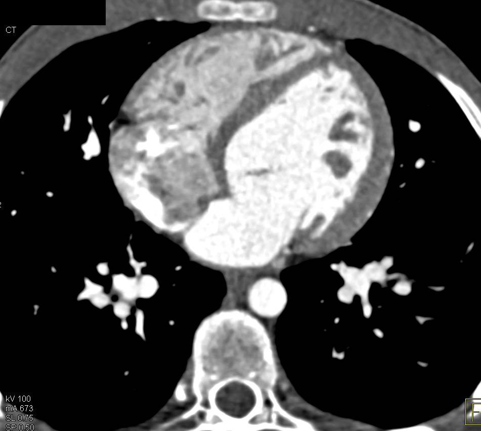 Dilated Sinus of Valsalva with Bicuspid Aortic Valve in Marfan Syndrome - CTisus CT Scan