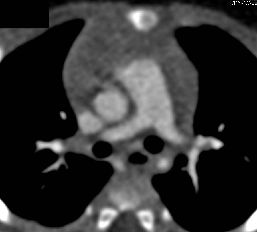 Coarctation of the Aorta - CTisus CT Scan