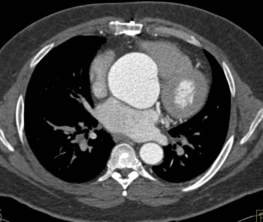 Dilated Aortic Root in Marfan Syndrome - CTisus CT Scan