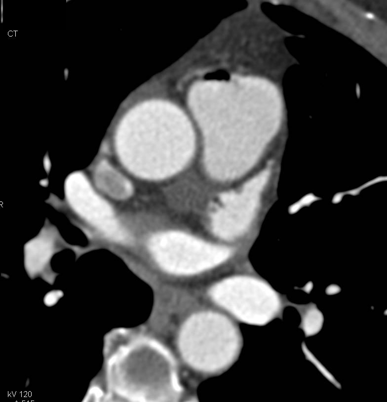 Left Atrial Appendage - CTisus CT Scan