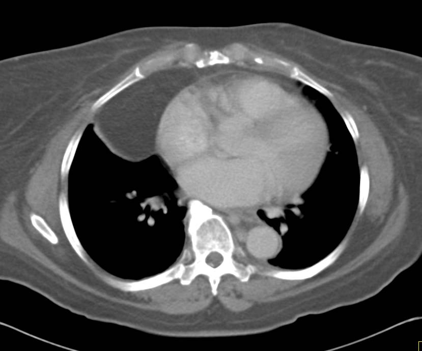 Pericardial Lipoma - CTisus CT Scan