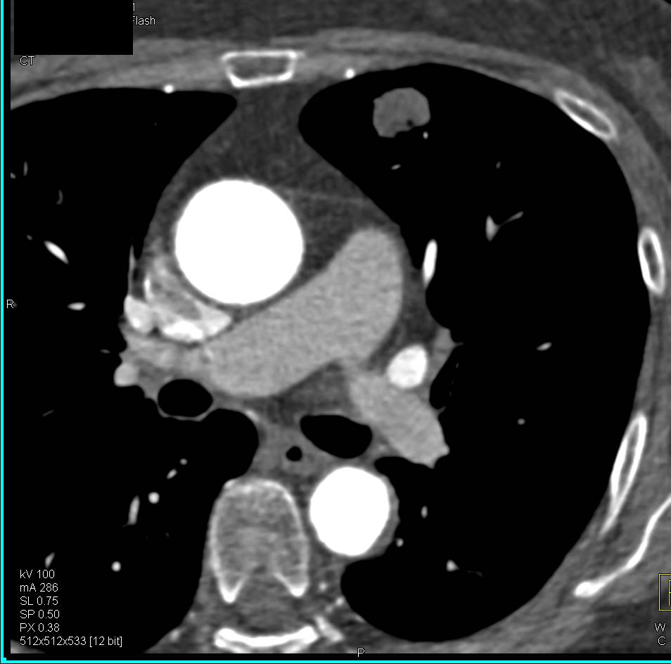 Bicuspid Aortic Valve with Dilated Ascending Aorta. incidental Left Upper Lung Nodule Also Seen - CTisus CT Scan