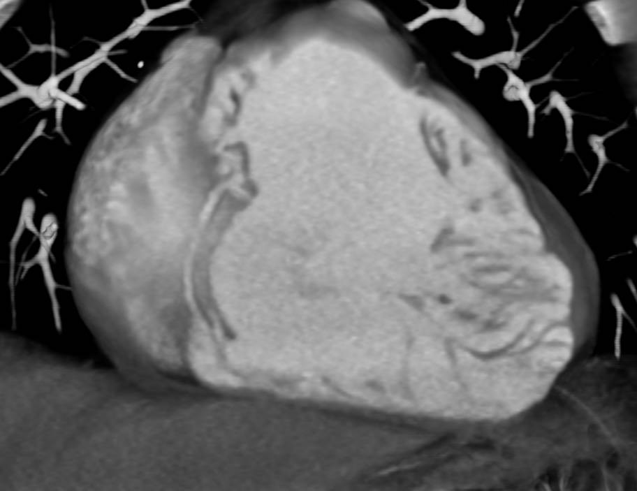 Large Atrial Septal Defect (ASD) - CTisus CT Scan